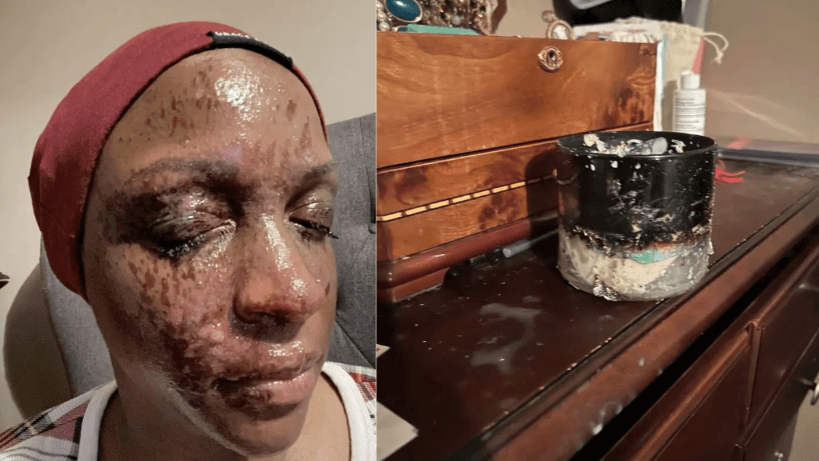 Renita Francois sustained severe facial burns after a Bath & Body Works candle allegedly exploded, as seen alongside the remains of the scorched candle container on her dresser.